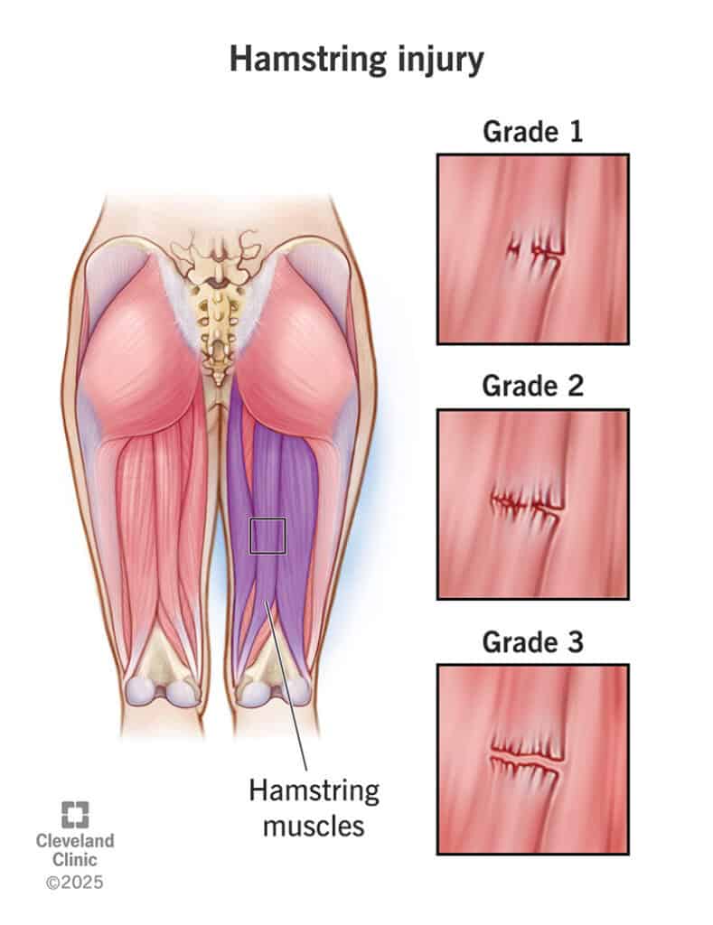 hamstring injury